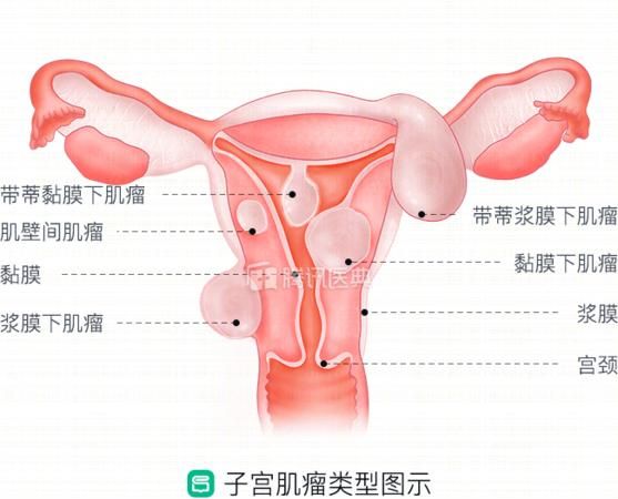 子宫位置在哪里,子宫在哪个位置图解6图6